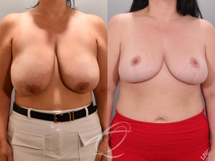 Breast Reduction Case 1002060 Before & After Front | Serving Rochester, Syracuse & Buffalo, NY | Quatela Center for Plastic Surgery