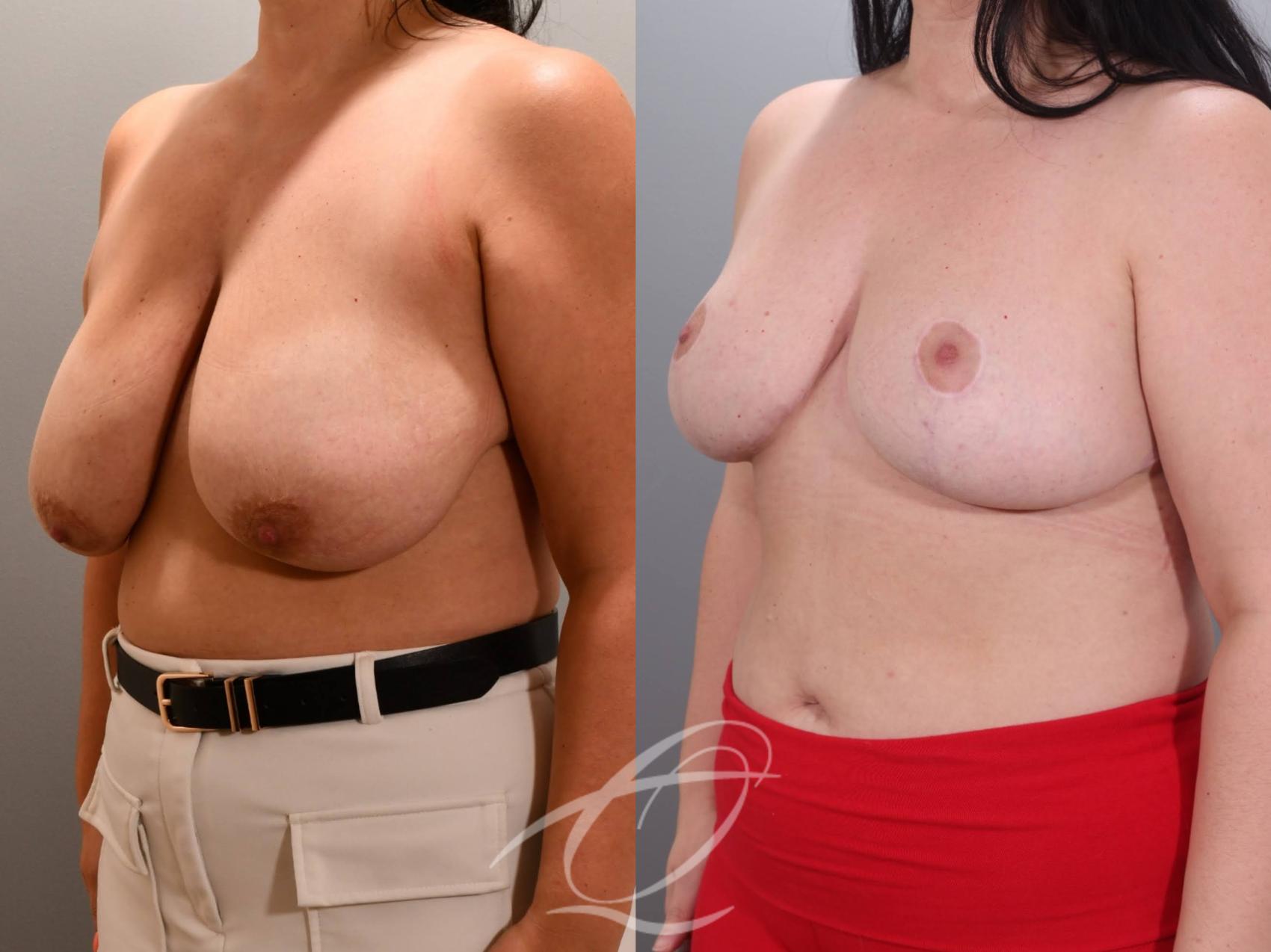 Breast Reduction Case 1002060 Before & After Left Oblique | Serving Rochester, Syracuse & Buffalo, NY | Quatela Center for Plastic Surgery