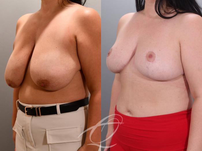 Breast Reduction Case 1002060 Before & After Left Oblique | Serving Rochester, Syracuse & Buffalo, NY | Quatela Center for Plastic Surgery