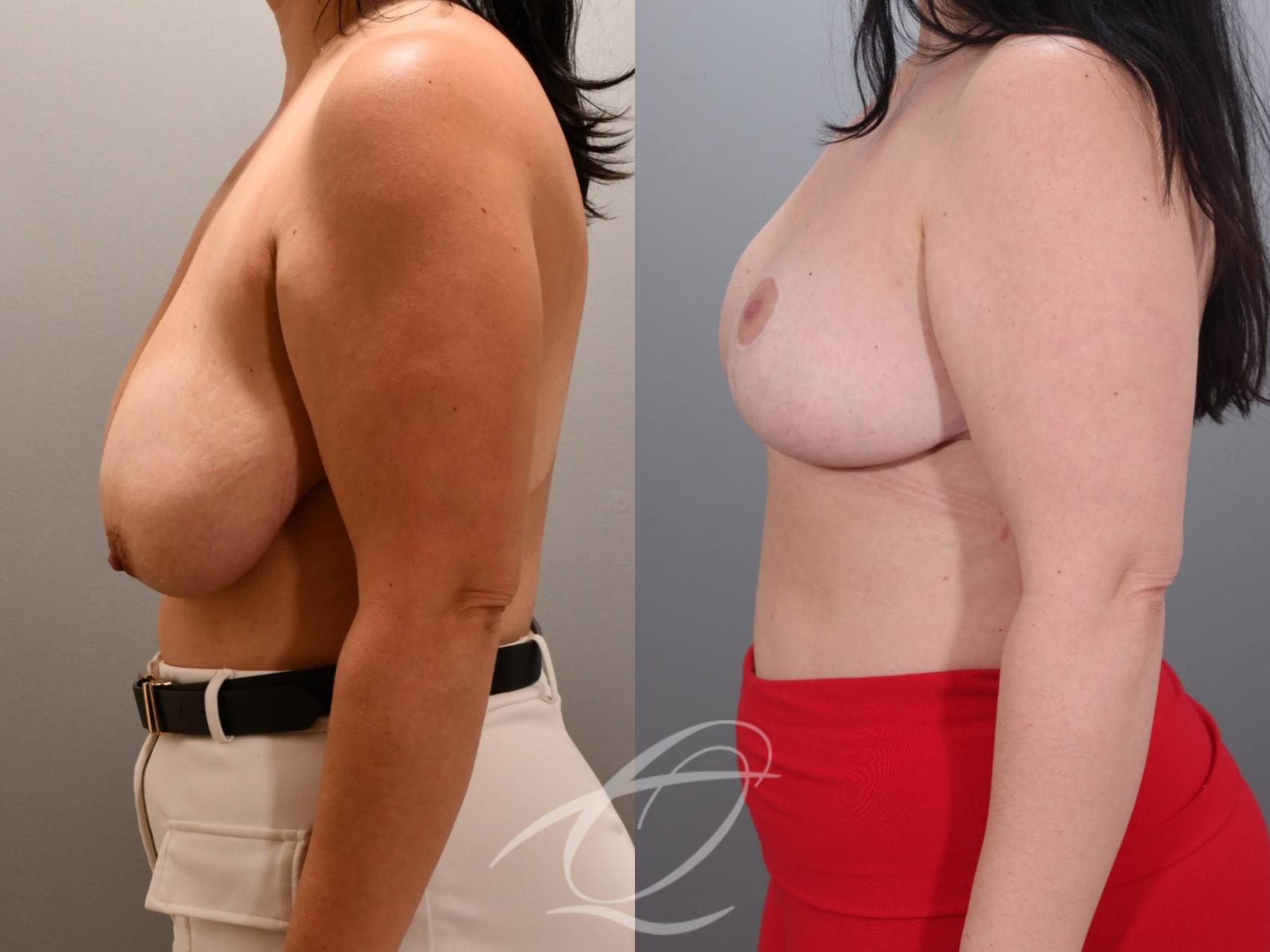 Breast Reduction Case 1002060 Before & After Left Side | Serving Rochester, Syracuse & Buffalo, NY | Quatela Center for Plastic Surgery