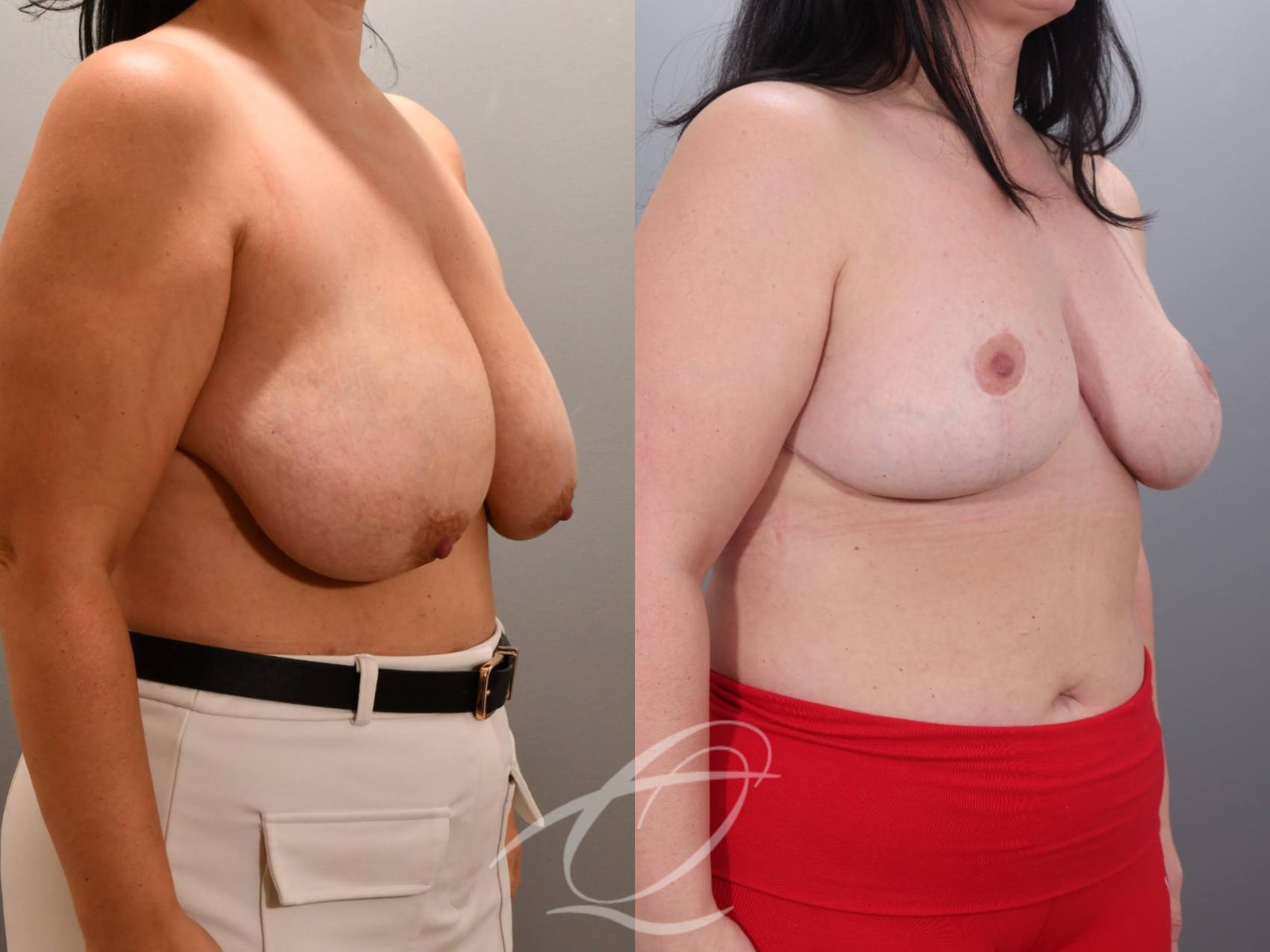 Breast Reduction Case 1002060 Before & After Right Oblique | Serving Rochester, Syracuse & Buffalo, NY | Quatela Center for Plastic Surgery