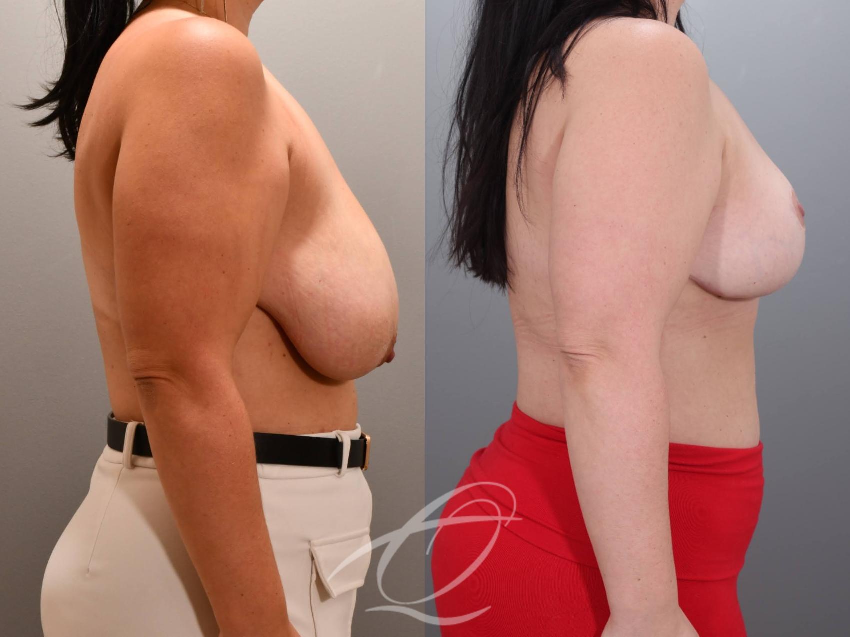 Breast Reduction Case 1002060 Before & After Right Side | Serving Rochester, Syracuse & Buffalo, NY | Quatela Center for Plastic Surgery