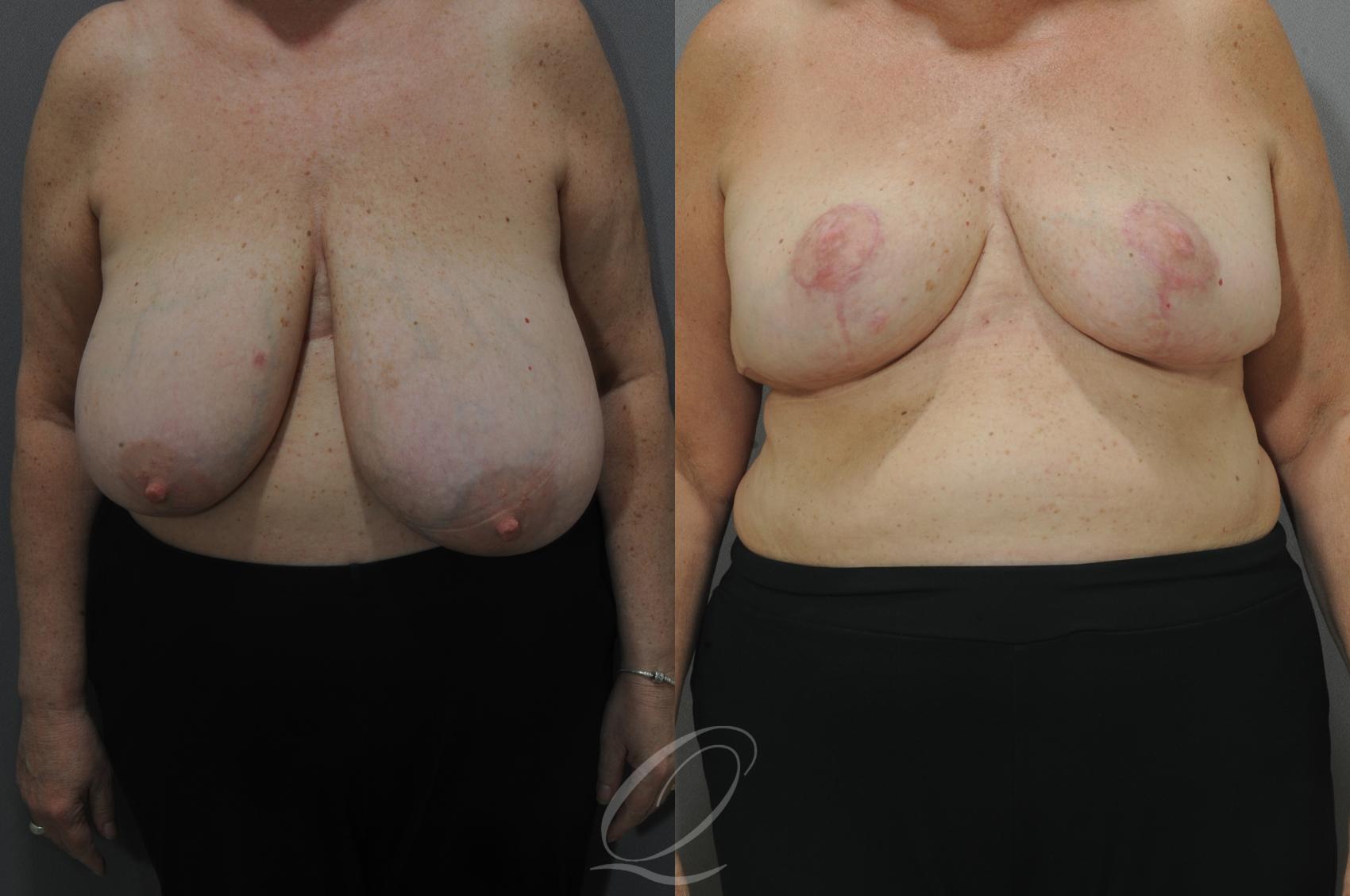 Breast Reduction Case 124 Before & After View #1 | Serving Rochester, Syracuse & Buffalo, NY | Quatela Center for Plastic Surgery