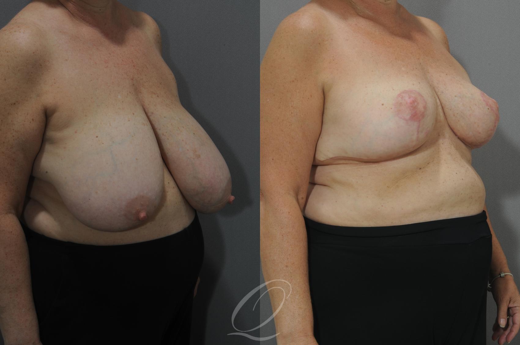 Breast Reduction Case 124 Before & After View #2 | Serving Rochester, Syracuse & Buffalo, NY | Quatela Center for Plastic Surgery