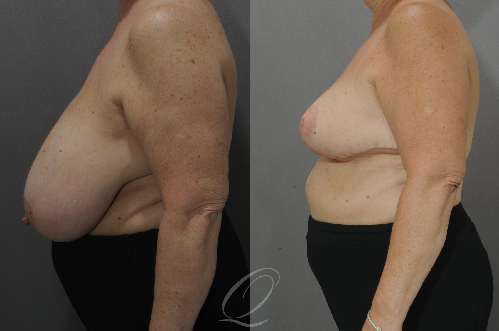Breast Reduction Case 124 Before & After View #3 | Serving Rochester, Syracuse & Buffalo, NY | Quatela Center for Plastic Surgery