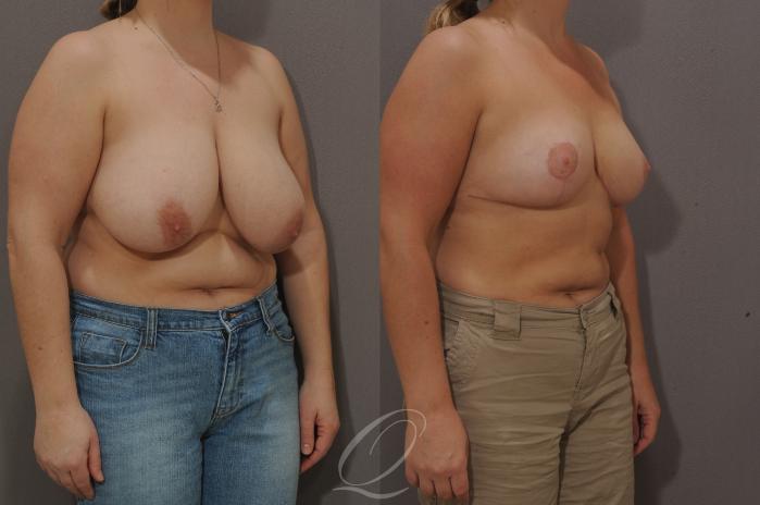 Breast Reduction Case 125 Before & After View #2 | Serving Rochester, Syracuse & Buffalo, NY | Quatela Center for Plastic Surgery