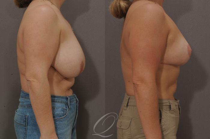 Breast Reduction Case 125 Before & After View #3 | Serving Rochester, Syracuse & Buffalo, NY | Quatela Center for Plastic Surgery