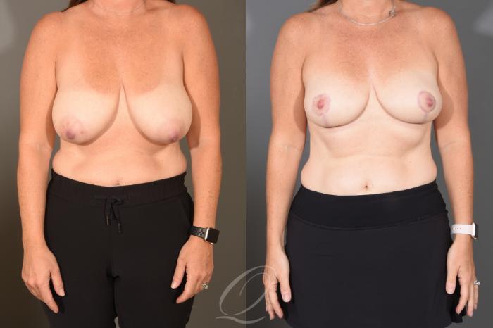 Breast Reduction Case 1488 Before & After Front | Serving Rochester, Syracuse & Buffalo, NY | Quatela Center for Plastic Surgery