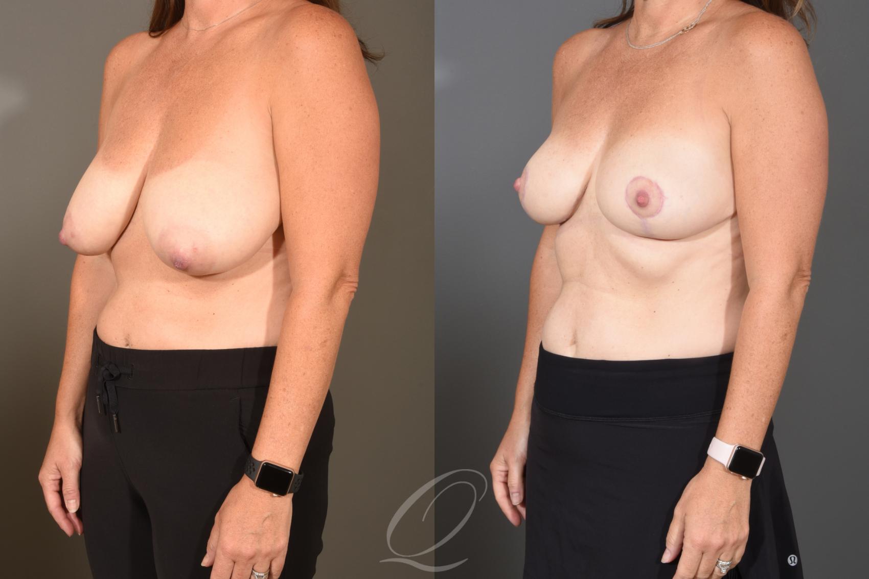 Breast Reduction Case 1488 Before & After Left Oblique | Serving Rochester, Syracuse & Buffalo, NY | Quatela Center for Plastic Surgery