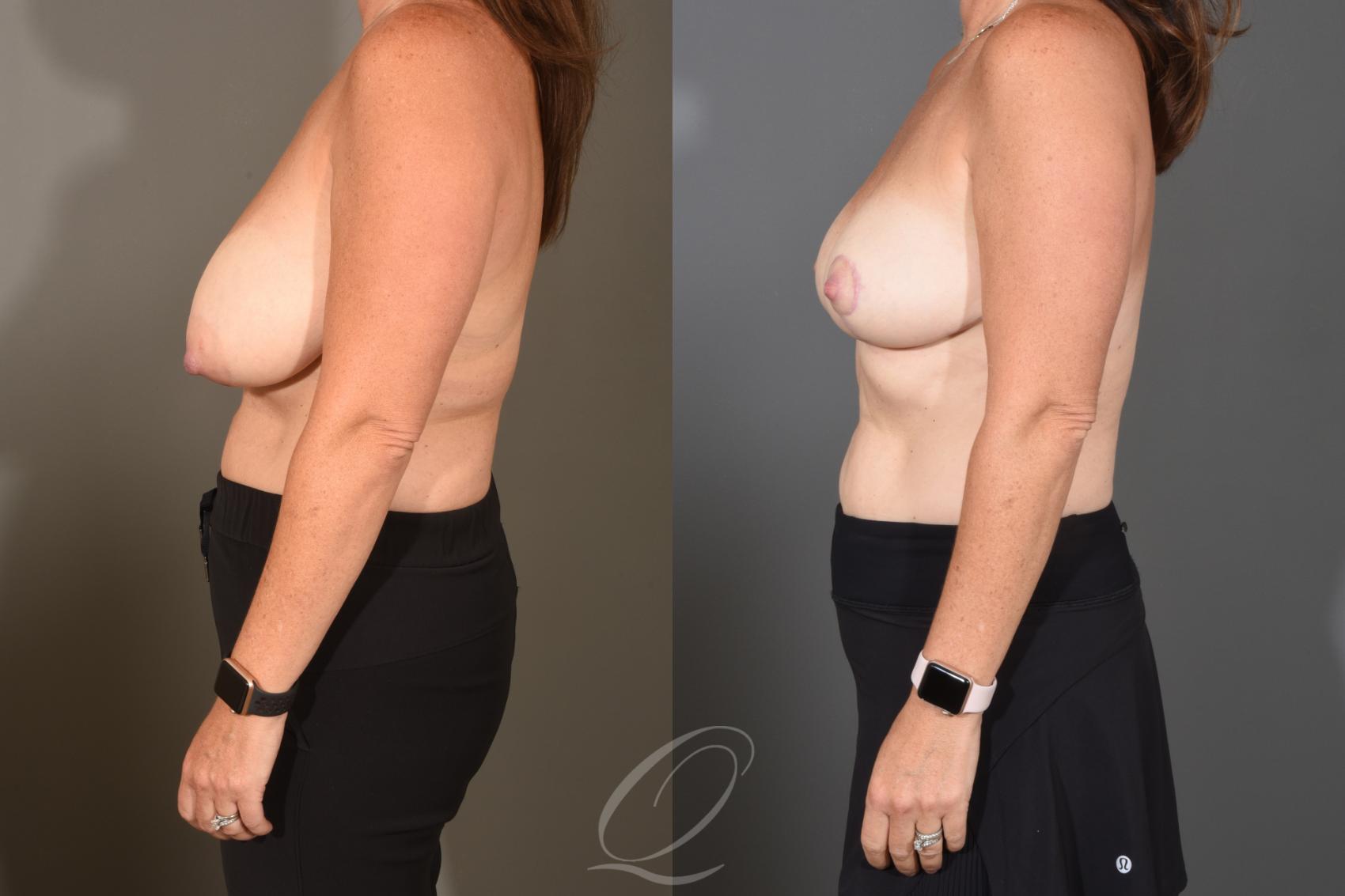 Breast Reduction Case 1488 Before & After Left Side | Serving Rochester, Syracuse & Buffalo, NY | Quatela Center for Plastic Surgery