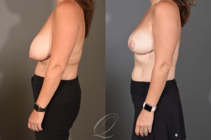 Breast Lift Case 1488 Before & After Left Side | Serving Rochester, Syracuse & Buffalo, NY | Quatela Center for Plastic Surgery