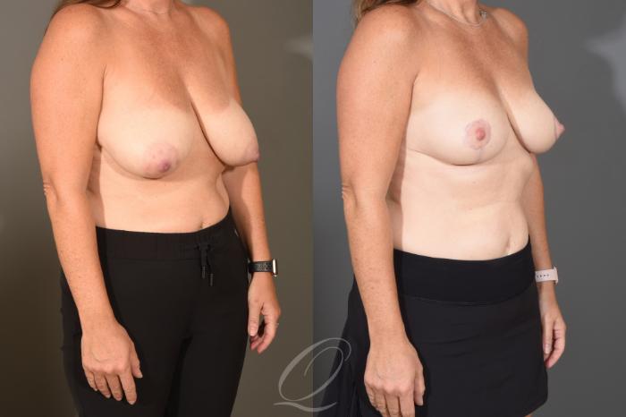 Breast Lift Case 1488 Before & After Right Oblique | Serving Rochester, Syracuse & Buffalo, NY | Quatela Center for Plastic Surgery