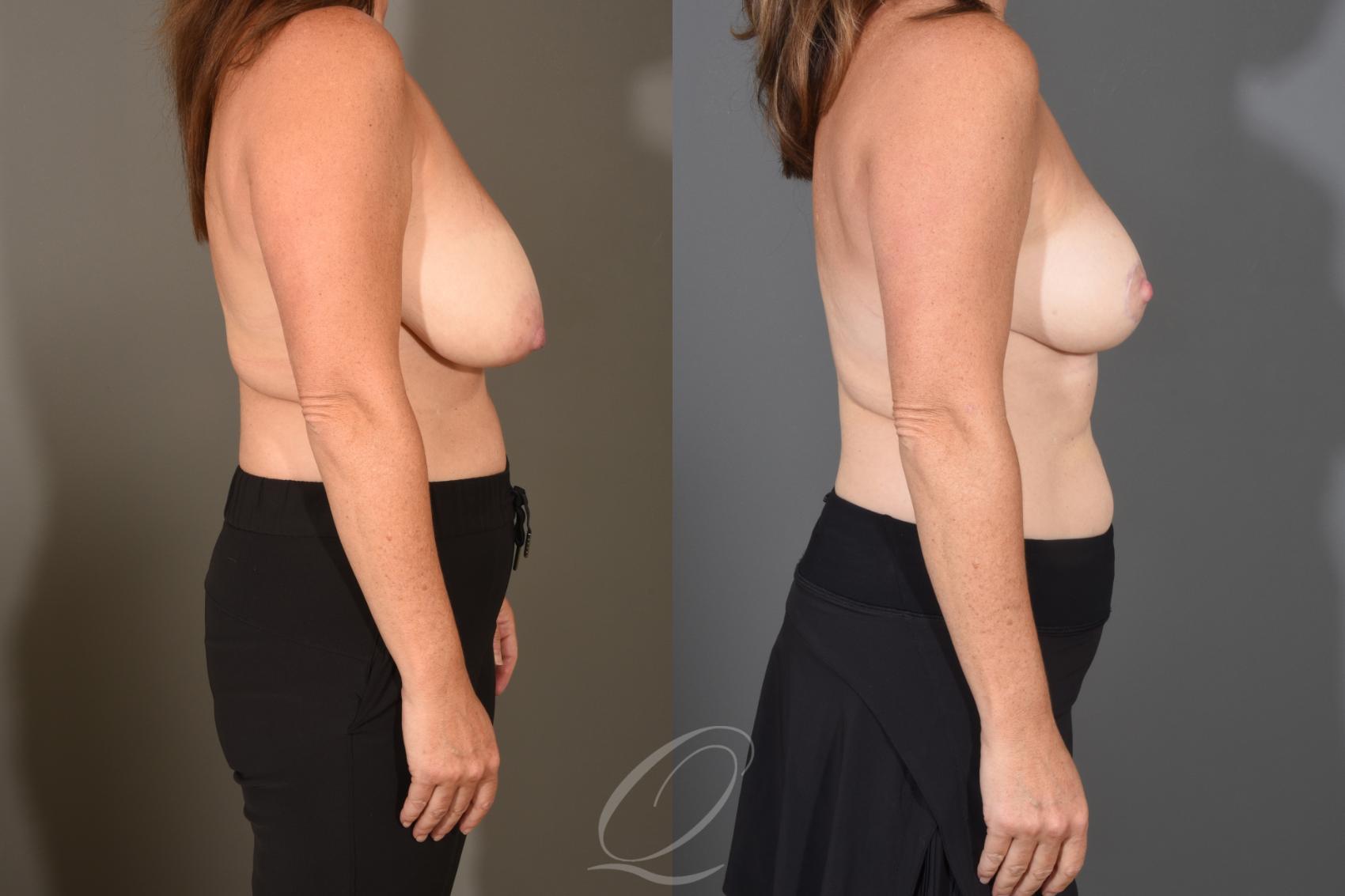 Breast Reduction Case 1488 Before & After Right Side | Serving Rochester, Syracuse & Buffalo, NY | Quatela Center for Plastic Surgery