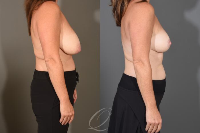 Breast Lift Case 1488 Before & After Right Side | Serving Rochester, Syracuse & Buffalo, NY | Quatela Center for Plastic Surgery