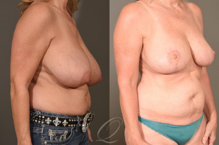 Breast Reduction Case 1489 Before & After Right Oblique | Serving Rochester, Syracuse & Buffalo, NY | Quatela Center for Plastic Surgery