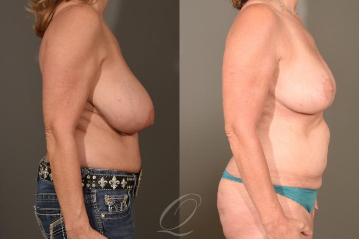 Breast Reduction Case 1489 Before & After Right Side | Serving Rochester, Syracuse & Buffalo, NY | Quatela Center for Plastic Surgery