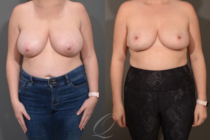 Breast Reduction Case 1490 Before & After Front | Serving Rochester, Syracuse & Buffalo, NY | Quatela Center for Plastic Surgery