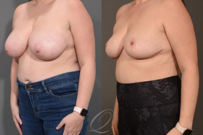 Breast Reduction Case 1490 Before & After Left Oblique | Serving Rochester, Syracuse & Buffalo, NY | Quatela Center for Plastic Surgery