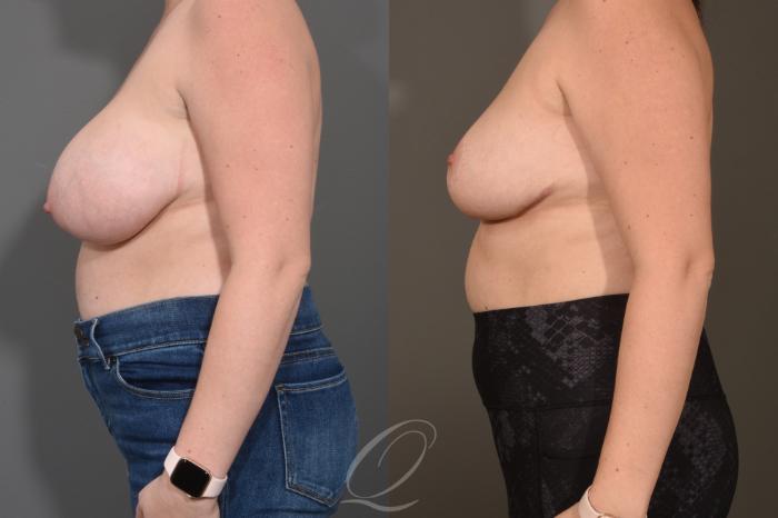 Breast Reduction Case 1490 Before & After Left Side | Serving Rochester, Syracuse & Buffalo, NY | Quatela Center for Plastic Surgery