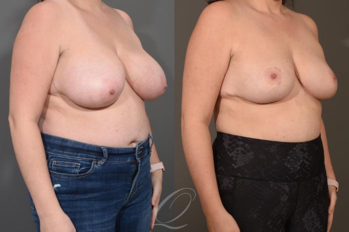 Breast Reduction Case 1490 Before & After Right Oblique | Serving Rochester, Syracuse & Buffalo, NY | Quatela Center for Plastic Surgery