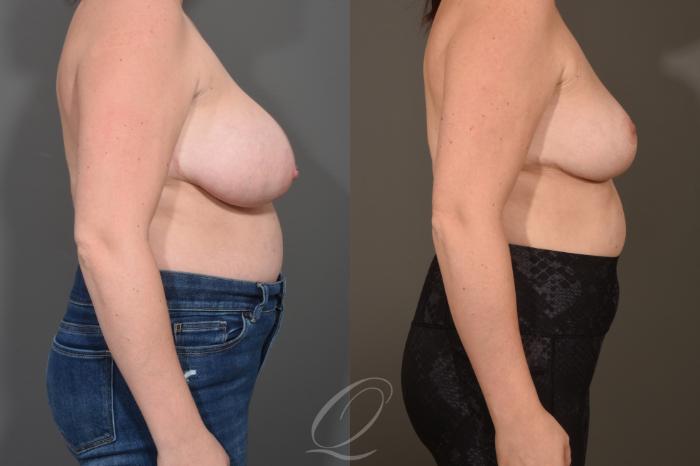 Breast Reduction Case 1490 Before & After Right Side | Serving Rochester, Syracuse & Buffalo, NY | Quatela Center for Plastic Surgery