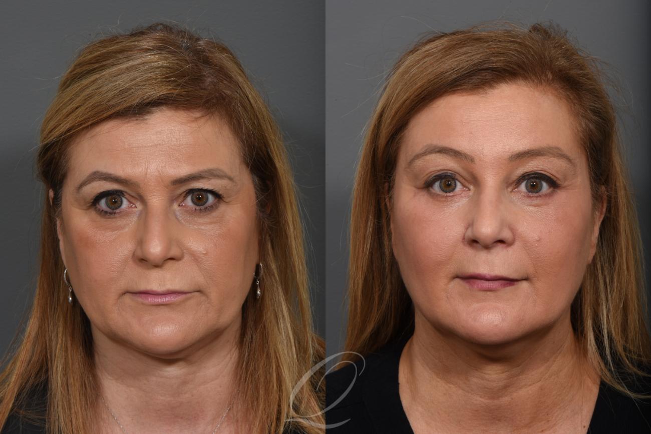Brow Lift Case 1273 Before & After View #1 | Serving Rochester, Syracuse & Buffalo, NY | Quatela Center for Plastic Surgery