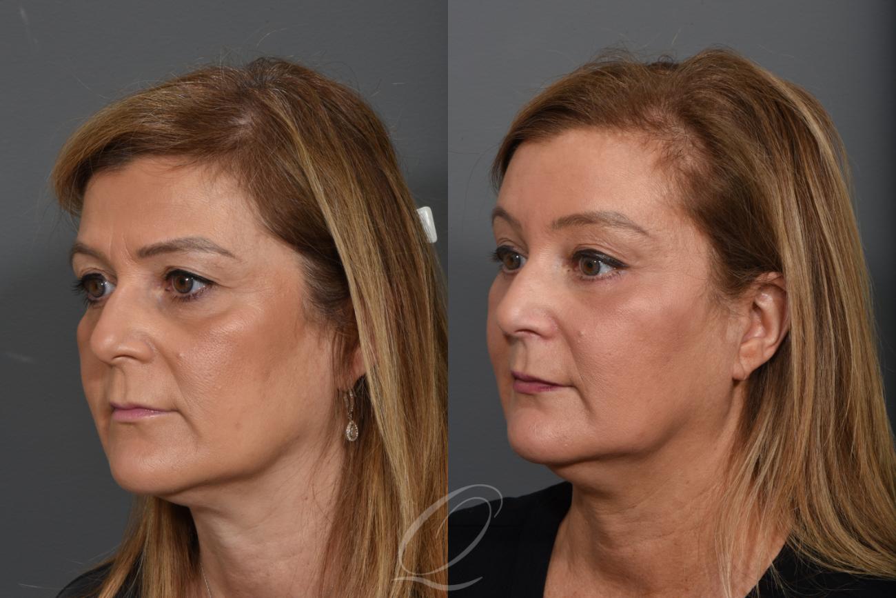 Brow Lift Case 1273 Before & After View #3 | Serving Rochester, Syracuse & Buffalo, NY | Quatela Center for Plastic Surgery