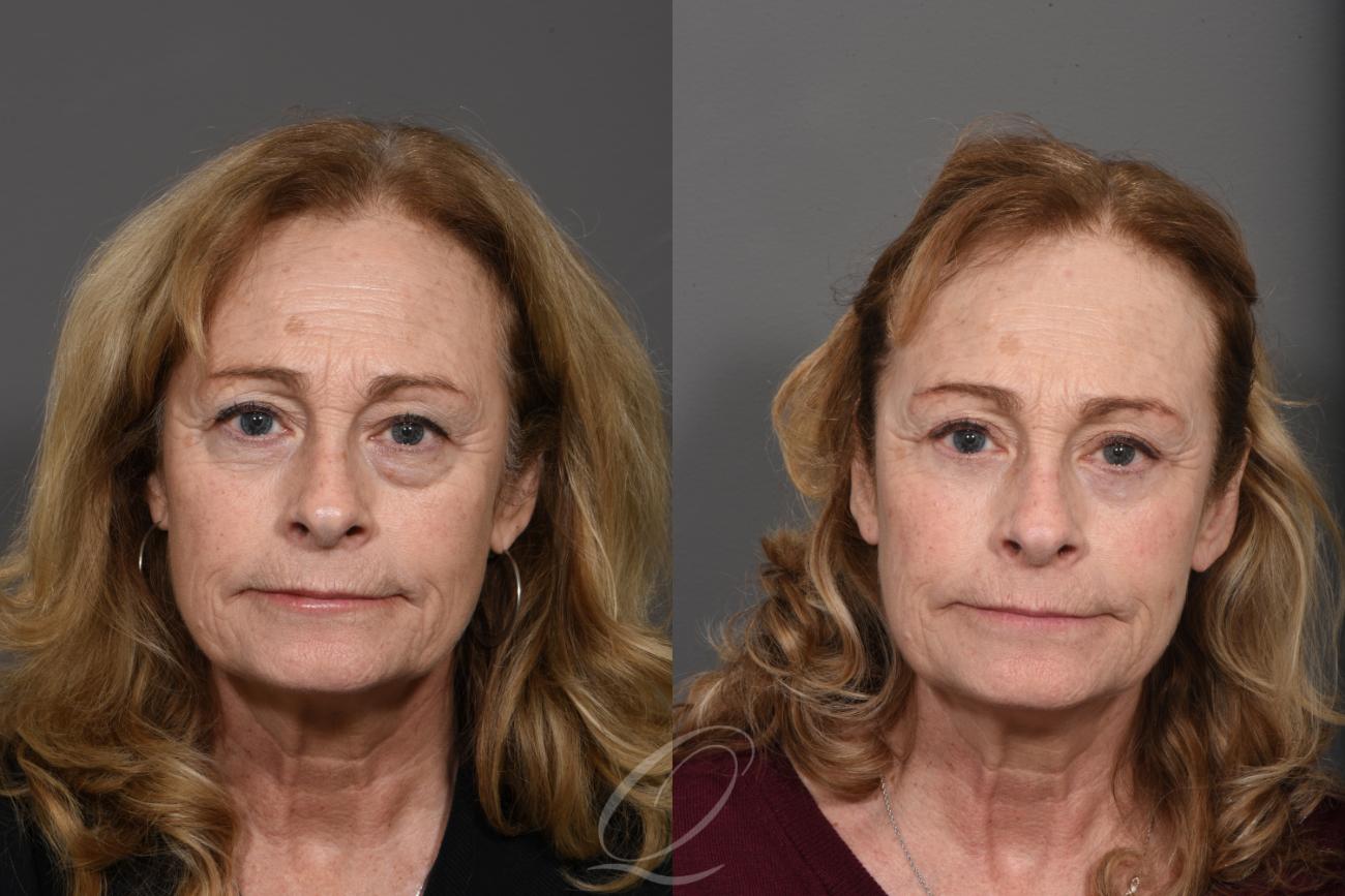 Brow Lift Case 1415 Before & After Front | Serving Rochester, Syracuse & Buffalo, NY | Quatela Center for Plastic Surgery