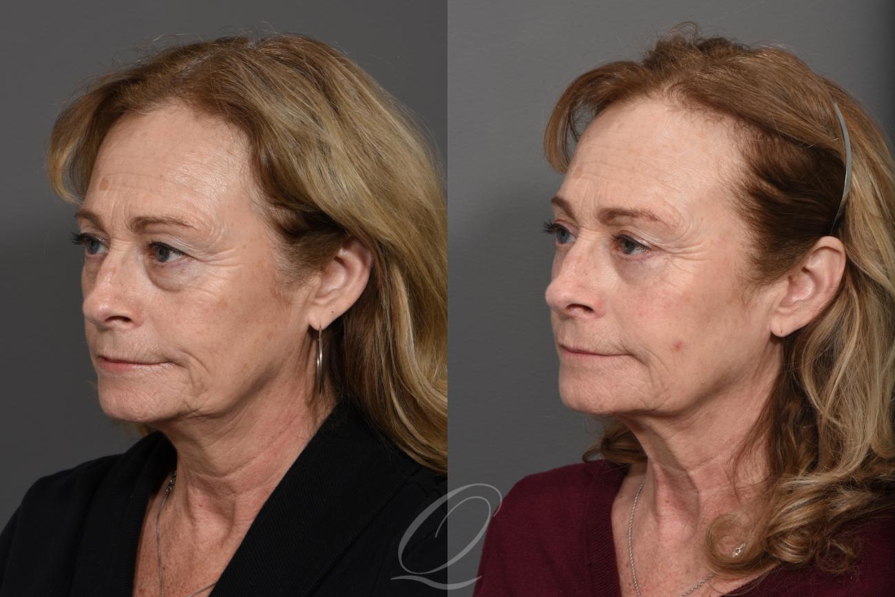 Brow Lift Case 1415 Before & After Left Oblique | Serving Rochester, Syracuse & Buffalo, NY | Quatela Center for Plastic Surgery