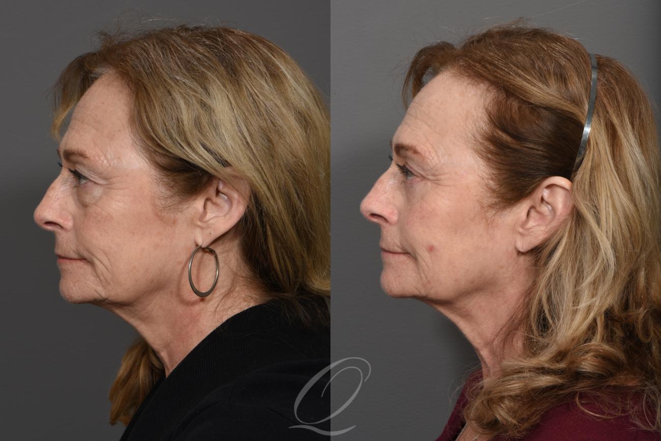 Brow Lift Case 1415 Before & After Left Side | Serving Rochester, Syracuse & Buffalo, NY | Quatela Center for Plastic Surgery