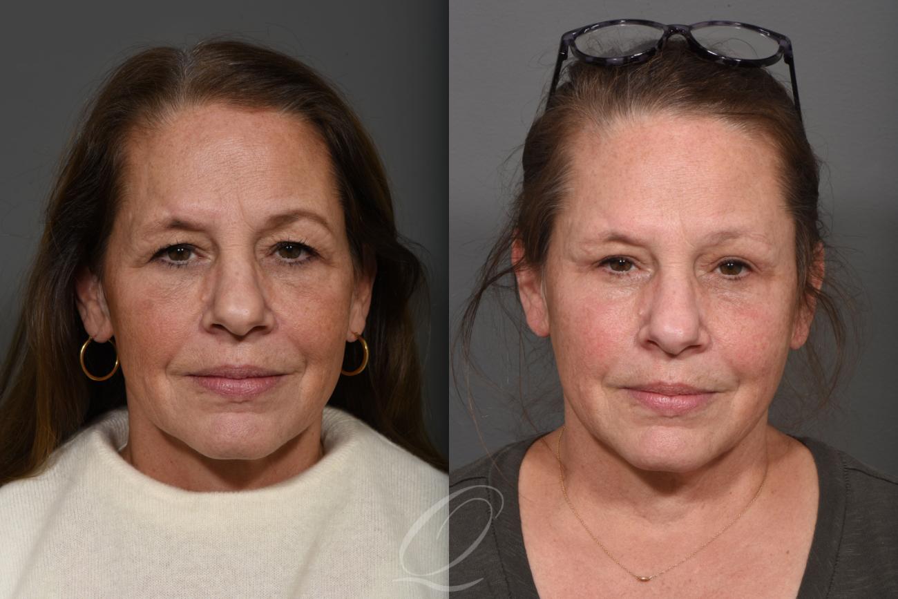 Eyelid Lift Case 1416 Before & After Front | Serving Rochester, Syracuse & Buffalo, NY | Quatela Center for Plastic Surgery