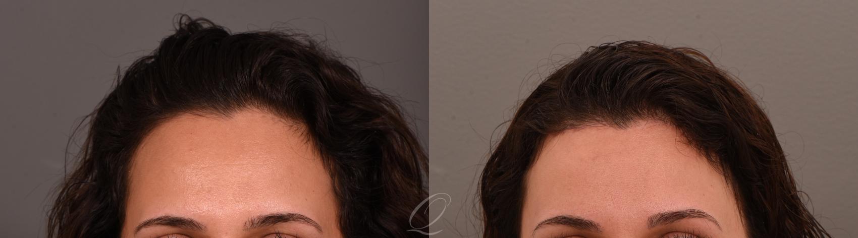 Brow Lift Case 1001672 Before & After Front | Serving Rochester, Syracuse & Buffalo, NY | Quatela Center for Plastic Surgery