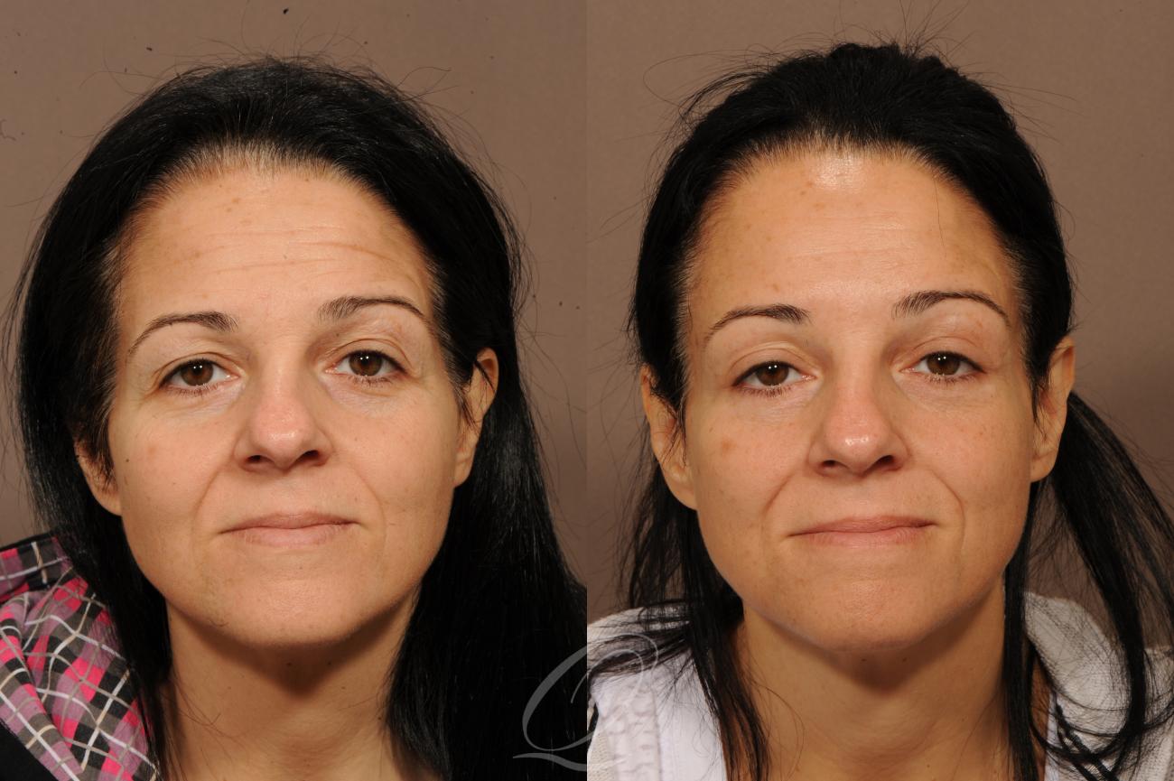Brow Lift Case 292 Before & After View #1 | Serving Rochester, Syracuse & Buffalo, NY | Quatela Center for Plastic Surgery