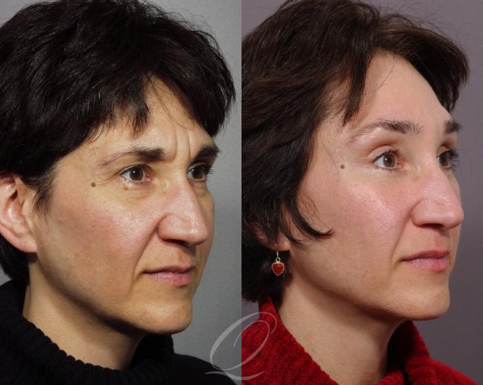 Brow Lift Case 127 Before & After View #2 | Serving Rochester, Syracuse & Buffalo, NY | Quatela Center for Plastic Surgery