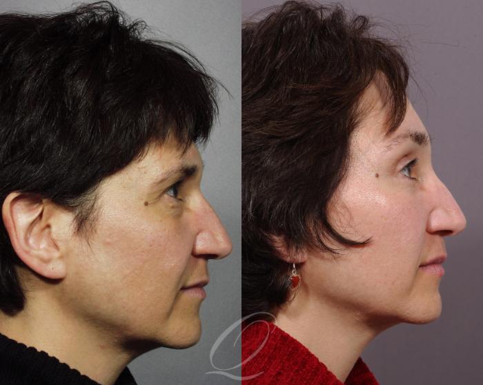 Brow Lift Case 127 Before & After View #3 | Serving Rochester, Syracuse & Buffalo, NY | Quatela Center for Plastic Surgery