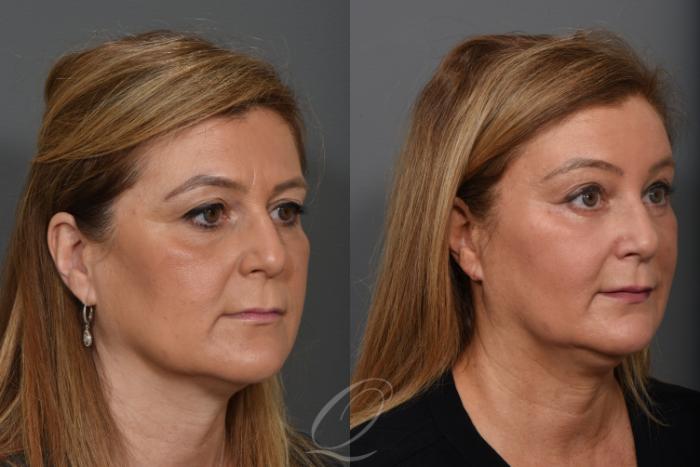 Mid Facelift Case 1273 Before & After View #2 | Serving Rochester, Syracuse & Buffalo, NY | Quatela Center for Plastic Surgery