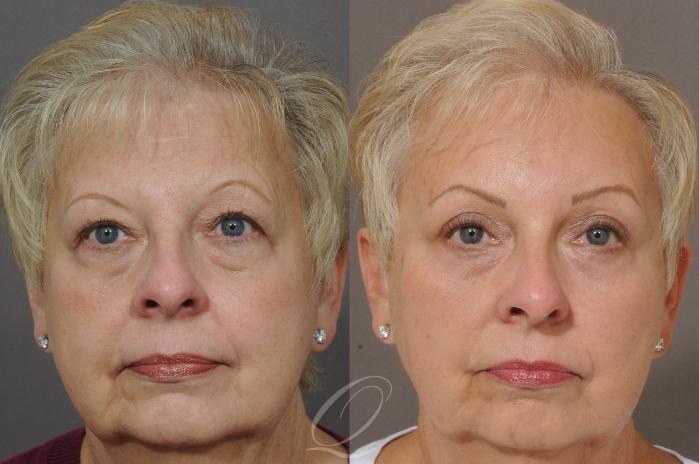 Brow Lift Case 128 Before & After View #1 | Serving Rochester, Syracuse & Buffalo, NY | Quatela Center for Plastic Surgery