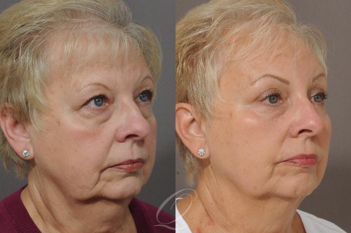 Brow Lift Case 128 Before & After View #2 | Serving Rochester, Syracuse & Buffalo, NY | Quatela Center for Plastic Surgery