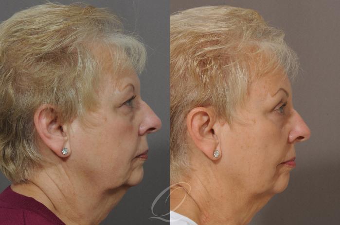 Brow Lift Case 128 Before & After View #3 | Serving Rochester, Syracuse & Buffalo, NY | Quatela Center for Plastic Surgery