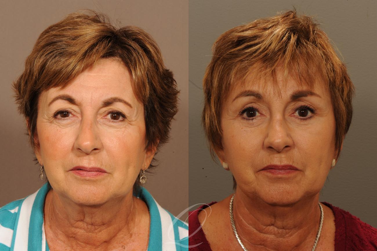 Eyelid Lift Case 302 Before & After View #1 | Serving Rochester, Syracuse & Buffalo, NY | Quatela Center for Plastic Surgery