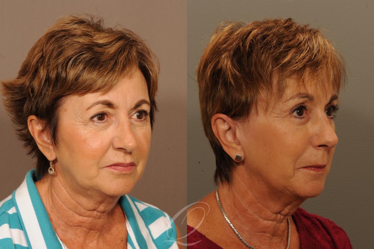 Brow Lift Case 302 Before & After View #2 | Serving Rochester, Syracuse & Buffalo, NY | Quatela Center for Plastic Surgery