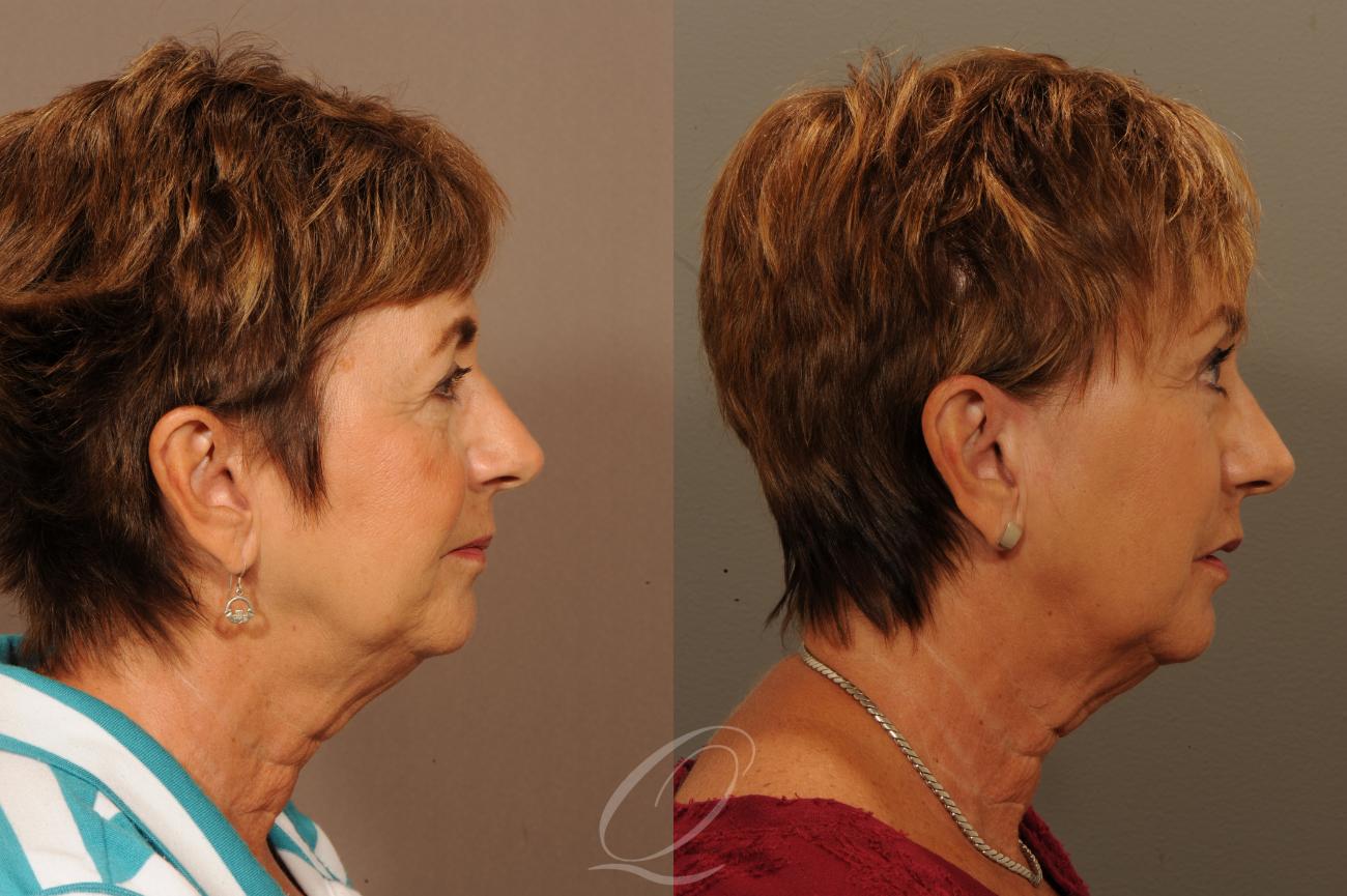 Brow Lift Case 302 Before & After View #3 | Serving Rochester, Syracuse & Buffalo, NY | Quatela Center for Plastic Surgery