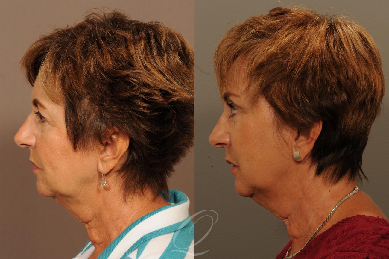 Brow Lift Case 302 Before & After View #4 | Serving Rochester, Syracuse & Buffalo, NY | Quatela Center for Plastic Surgery