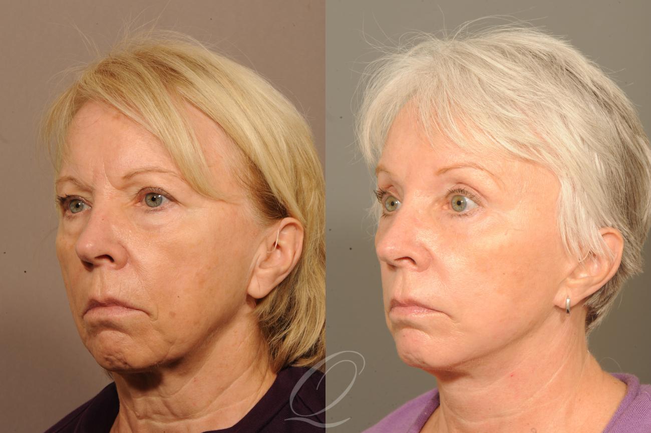 Skin Resurfacing Case 303 Before & After View #2 | Serving Rochester, Syracuse & Buffalo, NY | Quatela Center for Plastic Surgery