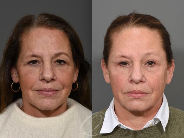 Eyelid Lift Case 1416 Before & After Front | Serving Rochester, Syracuse & Buffalo, NY | Quatela Center for Plastic Surgery