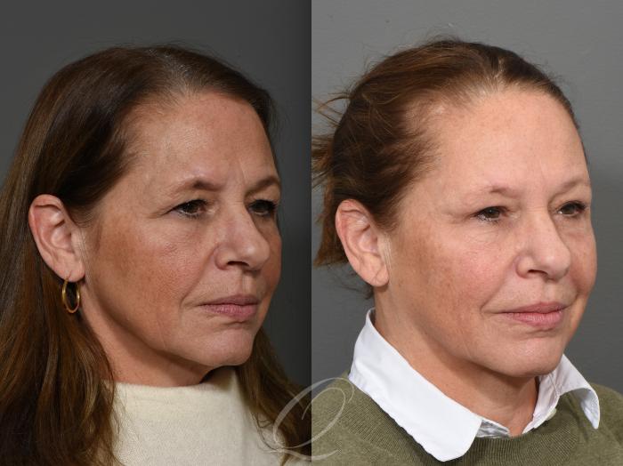 Eyelid Lift Case 1416 Before & After Right Oblique | Serving Rochester, Syracuse & Buffalo, NY | Quatela Center for Plastic Surgery