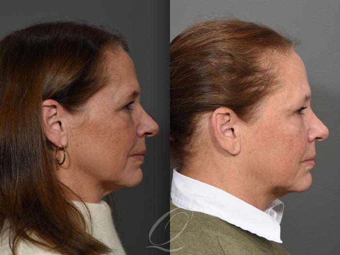 Eyelid Lift Case 1416 Before & After Right Side | Serving Rochester, Syracuse & Buffalo, NY | Quatela Center for Plastic Surgery