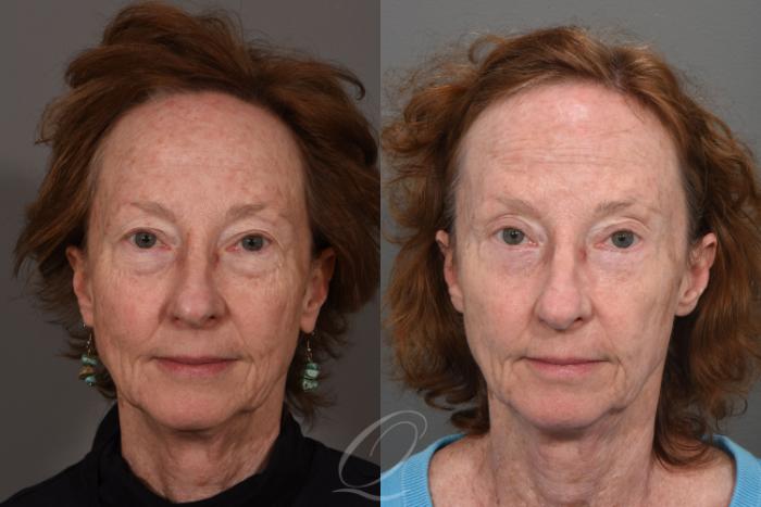 Brow Lift Case 1418 Before & After Front | Serving Rochester, Syracuse & Buffalo, NY | Quatela Center for Plastic Surgery