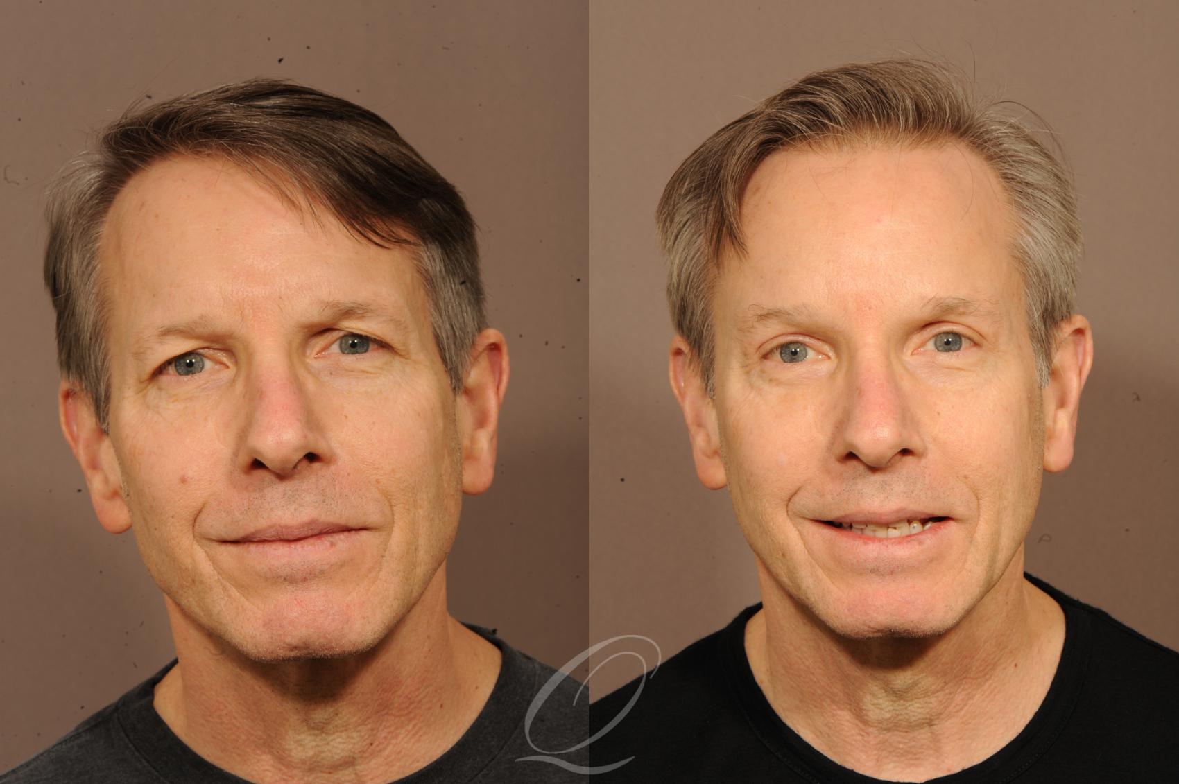 Brow Lift Case 291 Before & After View #1 | Serving Rochester, Syracuse & Buffalo, NY | Quatela Center for Plastic Surgery