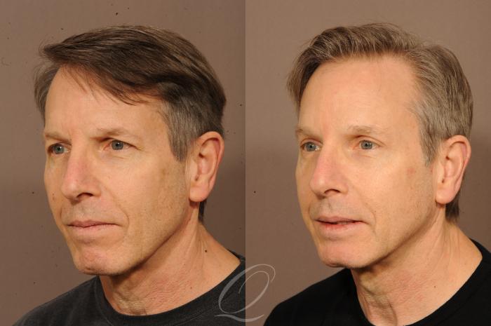 Brow Lift Case 291 Before & After View #2 | Serving Rochester, Syracuse & Buffalo, NY | Quatela Center for Plastic Surgery